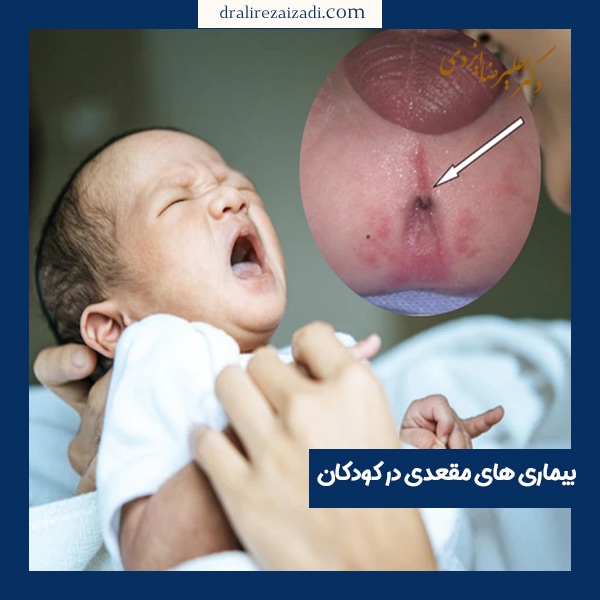 بیماری های مقعدی در کودکان - دکتر ایزدی