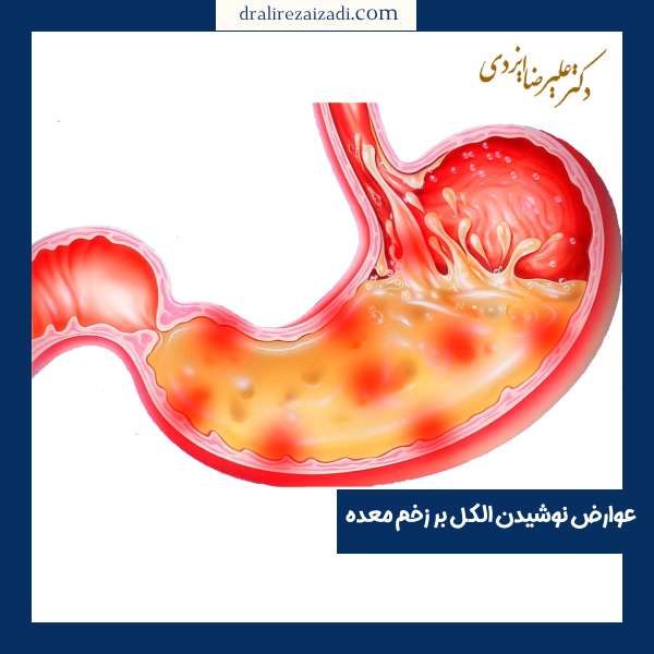 عوارض نوشیدنی های الکلی بر زخم معده