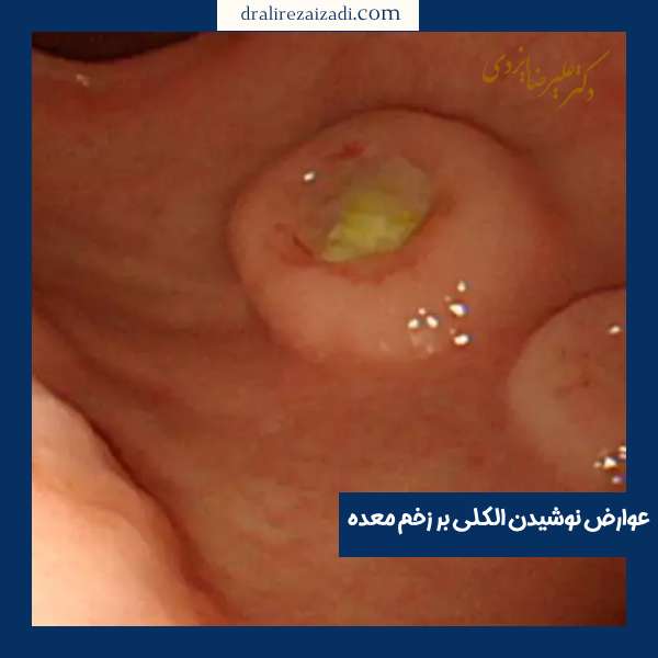 عکس زخم معده در اثر نوشیدن الکل