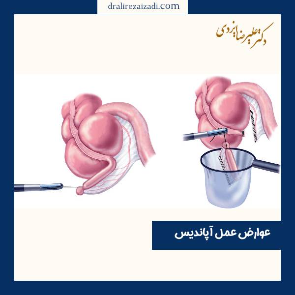 عوارض بعد از عمل آپاندیس