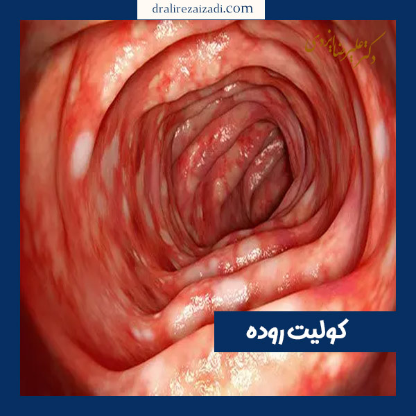 کولیت روده - دکتر علیرضا ایزدی