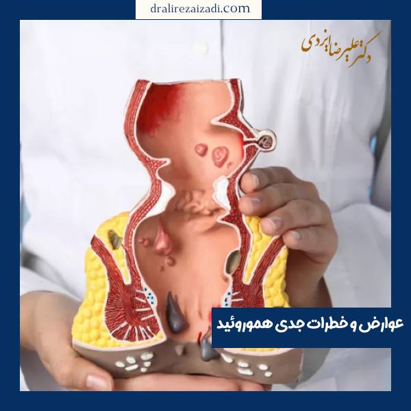 عوارض جدی هموروئید