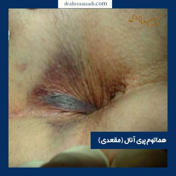 هماتوم مقعد