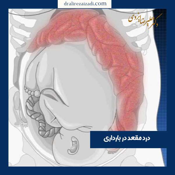 درد مقعد در بارداری