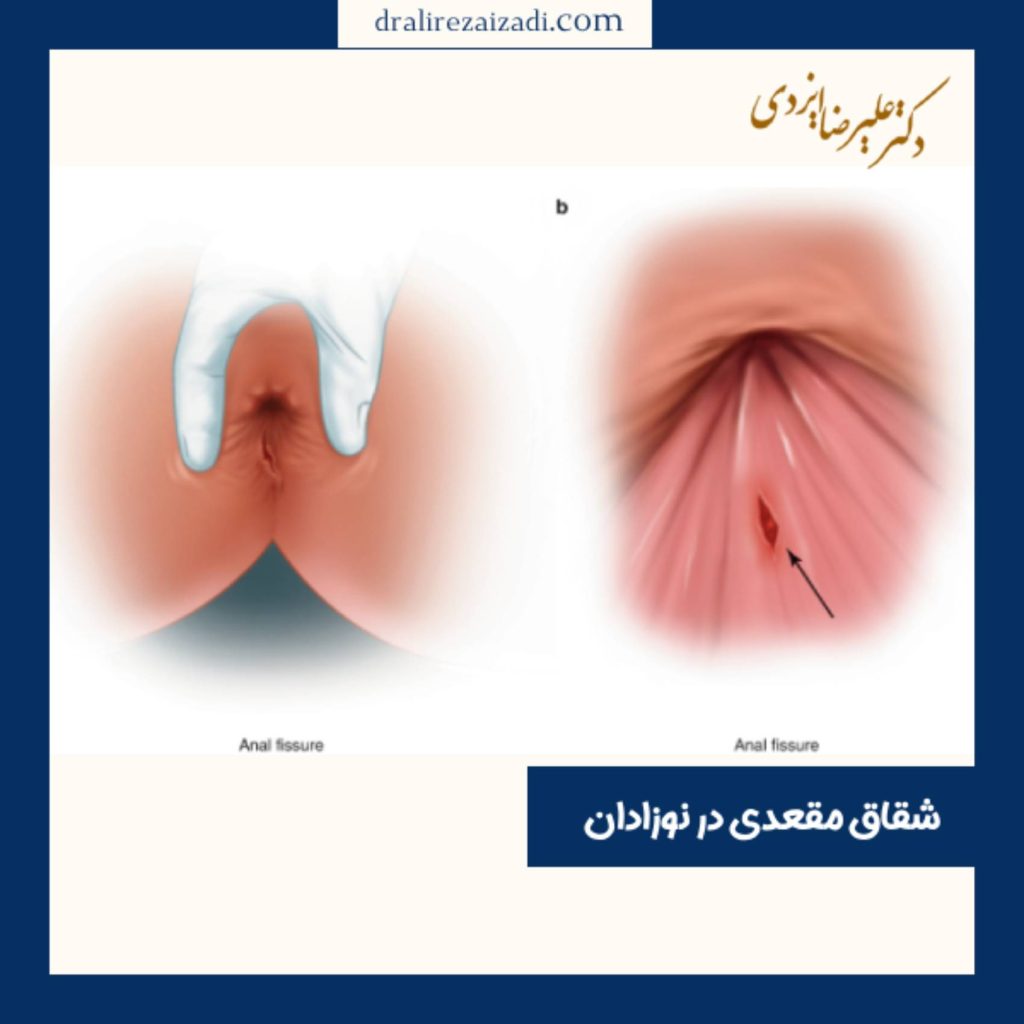 شقاق مقعدی در نوزادان - دکتر علیرضا ایزدی