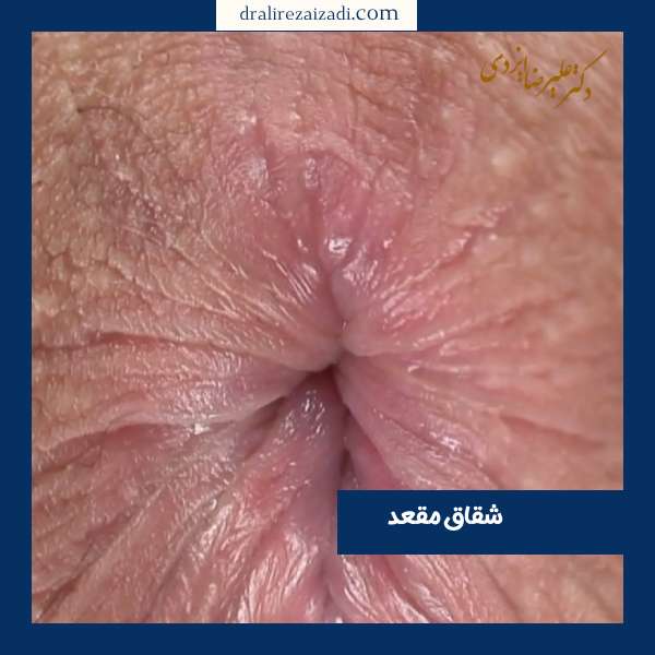 عکس شقاق مقعد 