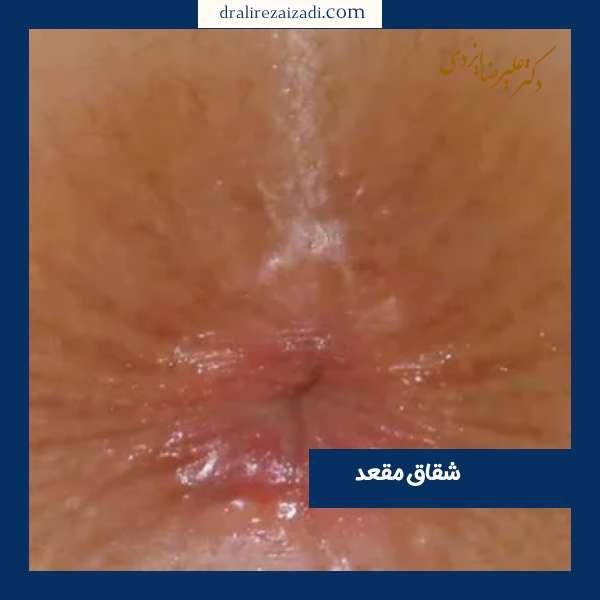 شقاق مقعد 