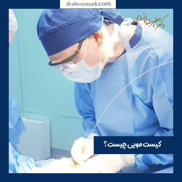 کیست مویی چیست؟