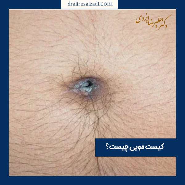 عکس کیست مویی