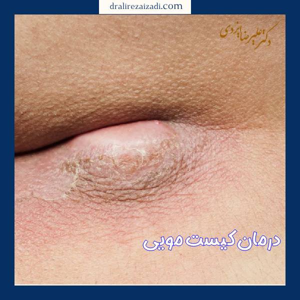 درمان کیست مویی