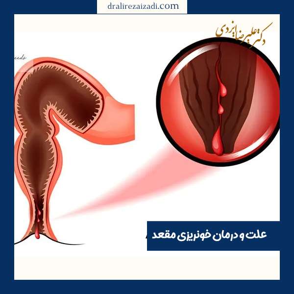 عکس خونریزی مقعد