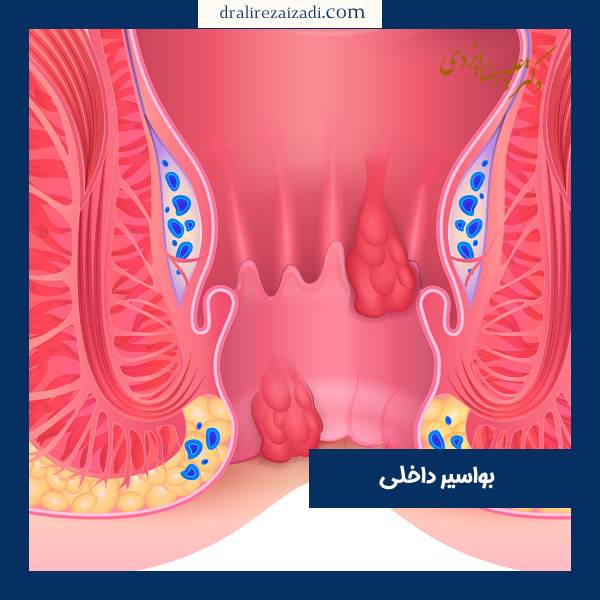عکس هموروئید داخلی