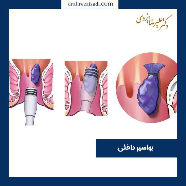 هموروئید داخلی 