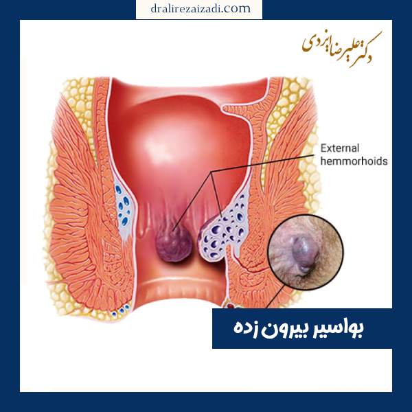 بواسیر بیرون زده - دکتر علیرضا ایزدی