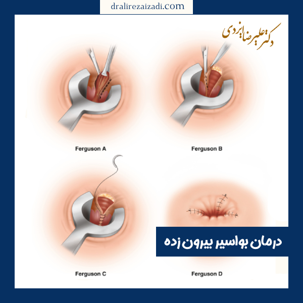 درمان بواسیر بیرون زده - دکتر علیرضا ایزدی