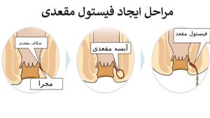 مراحل ایجاد فیستول مقعدی _ دکتر علیرضا ایزدی