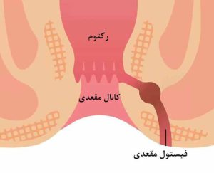 فیستول مقعدی _ دکتر علیرضا ایزدی