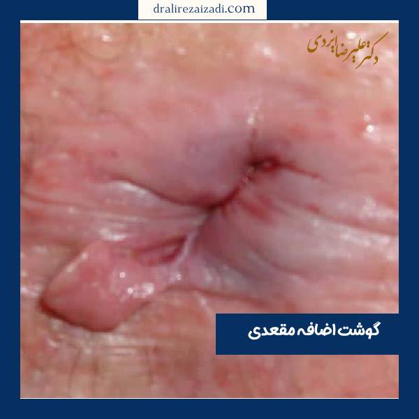 عکس گوشت اضافه مقعدی