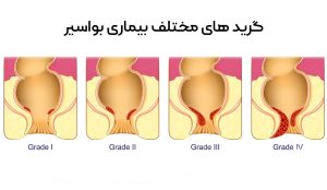 فرق یبوست و هموروئید _ دکتر علیرضا ایزدی