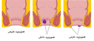 فرق بواسیر با یبوست _ دکتر علیرضا ایزدی