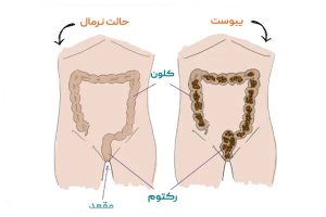 تفاوت یبوست و بواسیر _ دکتر علیرضا ایزدی