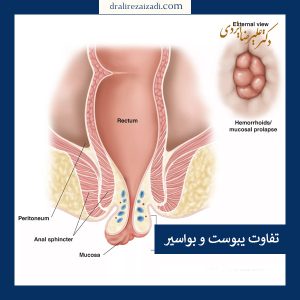 فرق هموروئید و یبوست _ دکتر علیرضا ایزدی