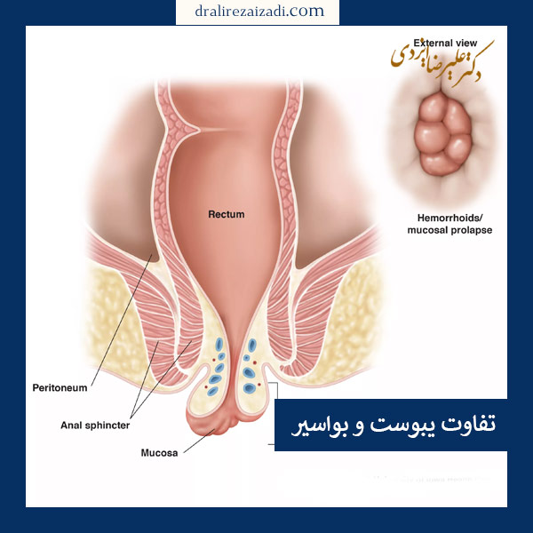 فرق هموروئید و یبوست _ دکتر علیرضا ایزدی