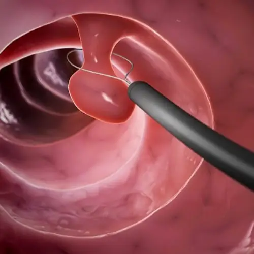 عکس کولونوسکوپی _ دکتر علیرضا ایزدی