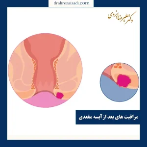 مراقبت های بعد از جراحی آبسه مقعدی _ دکتر علیرضا ایزدی