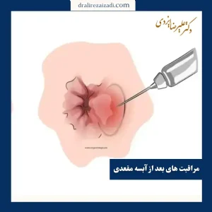 مراقبت های بعد از عمل آبسه مقعدی _ دکتر علیرضا ایزدی