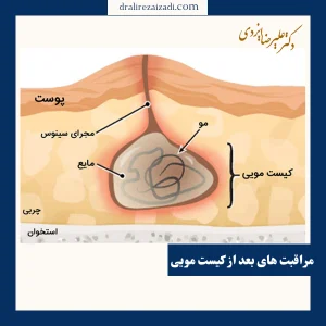 مراقبت های بعد از کیست مویی _ دکتر علیرضا ایزدی