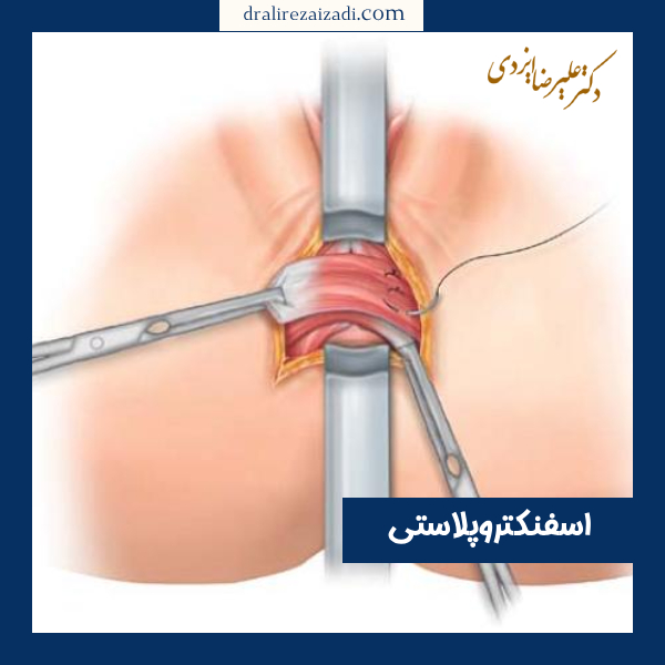 اسفنکتروپلاستی - دکتر علیرضا ایزدی https://dralirezaizadi.com/