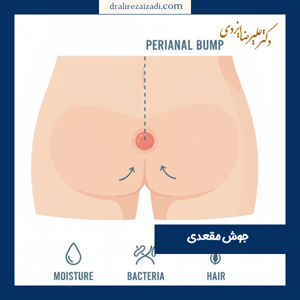 جوش مقعدی - دکتر ایزدی