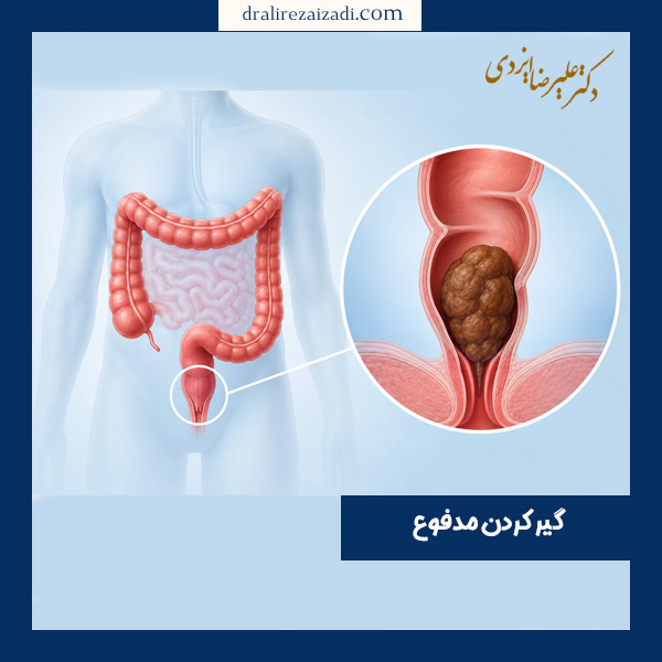 گیر کردن مدفوع - دکتر ایزدی