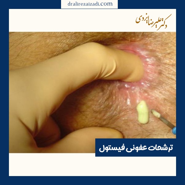 ترشحات عفونی فیستول