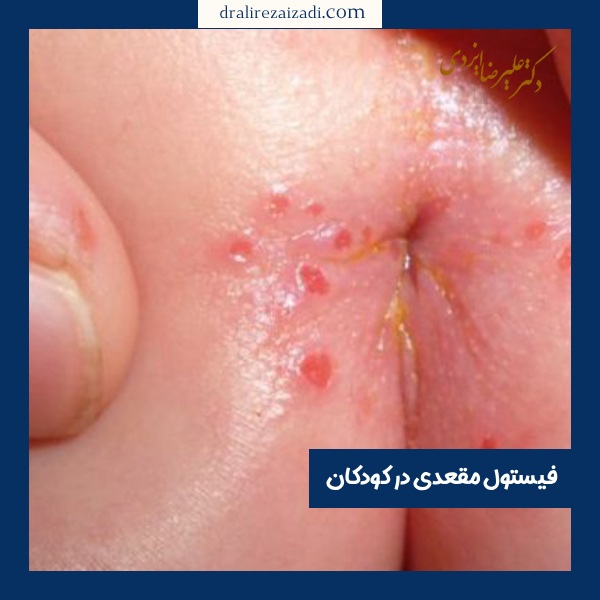 فیستول مقعدی در کودکان