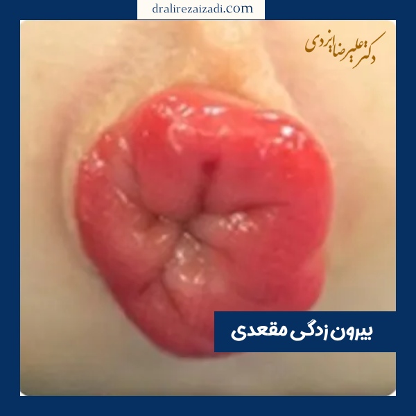 بیرون زدگی مقعدی